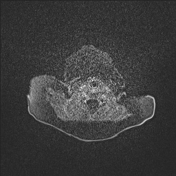 Aqueductal stenosis (Radiopaedia 73974-84802 Axial T1 C+ 2).jpg