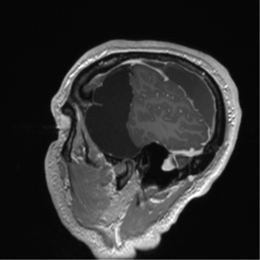 Arachnoid cyst with subdural hematoma (Radiopaedia 85892-101743 Sagittal T1 C+ 20).png