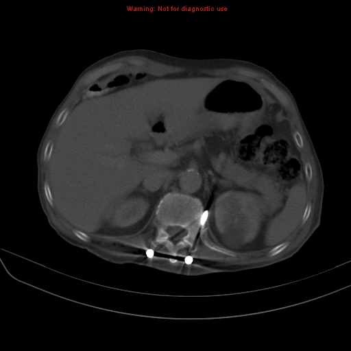File:Arachnoiditis ossificans (Radiopaedia 51394-57136 Axial bone window 8).jpg