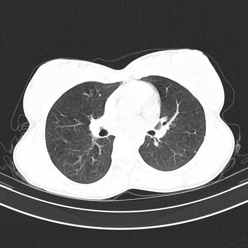File:Arteria lusoria (Radiopaedia 88528-105192 Axial lung window 32).jpg