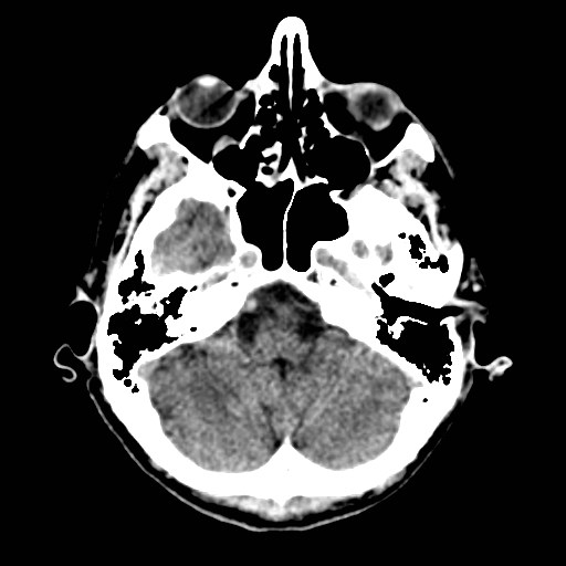 File:Artery of Percheron infarct (Radiopaedia 48088-52893 Axial non-contrast 7).jpg