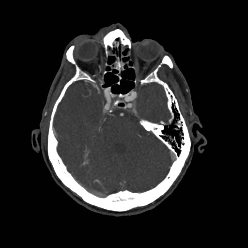 Artery of Percheron infarct (Radiopaedia 48088-52894 A 122).jpg