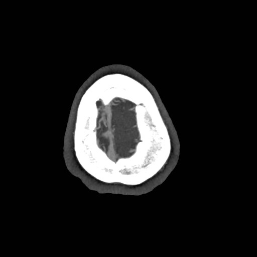 File:Artery of Percheron infarct (Radiopaedia 48088-52894 A 169).jpg