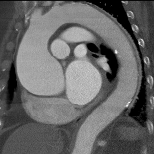 File:Ascending aortic aneurysm (Radiopaedia 20913-20846 A 17).jpg