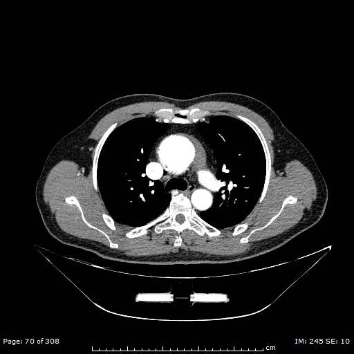 Ascending aortic aneurysm (Radiopaedia 50086-55404 A 21).jpg