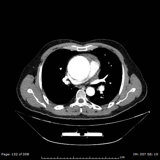 Ascending aortic aneurysm (Radiopaedia 50086-55404 A 35).jpg