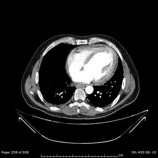Ascending aortic aneurysm (Radiopaedia 50086-55404 A 65).jpg