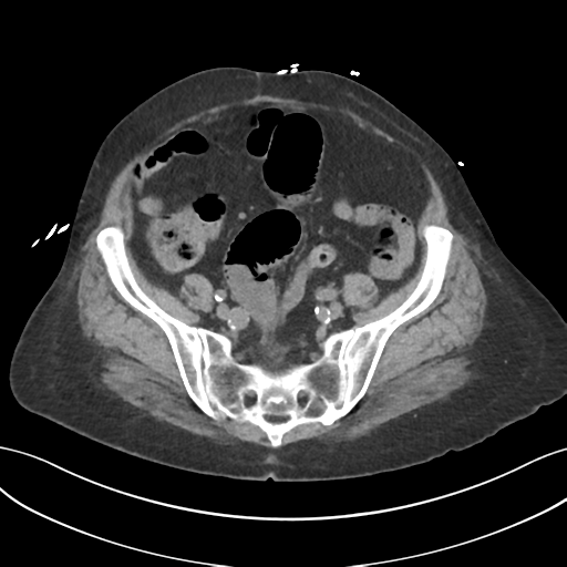 File:Ascending cholangitis (Radiopaedia 39068-41253 Axial non-contrast 49).png