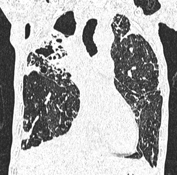 Aspergilloma- with Monod sign (Radiopaedia 44737-48532 Coronal lung window 227).jpg