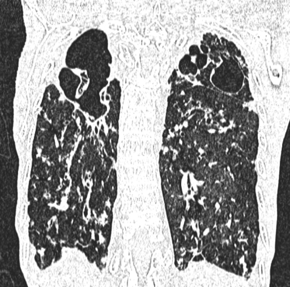 Aspergilloma- with Monod sign (Radiopaedia 44737-48532 Coronal lung window 344).jpg