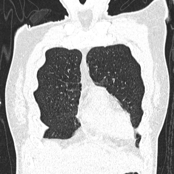 File:Aspergilloma (Radiopaedia 26223-26347 Coronal lung window 10).jpg