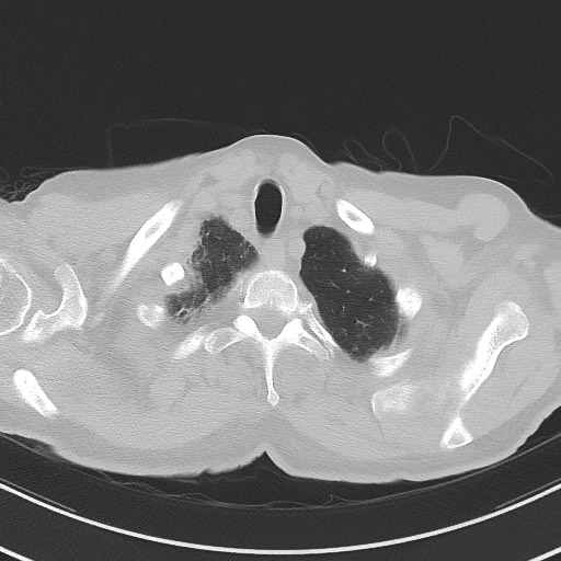 Aspergilloma on background pulmonary fibrosis (Radiopaedia 60942-68757 A 6).jpg