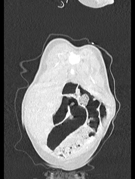 Asplenia syndrome (Radiopaedia 73083-83792 Coronal lung window 5).jpg