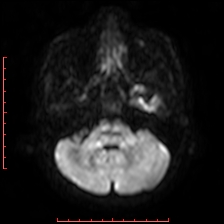 Astroblastoma (Radiopaedia 74287-85162 Axial DWI 17).jpg