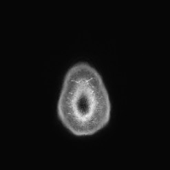 Astrocytoma (Radiopaedia 85660-101440 I 157).jpg