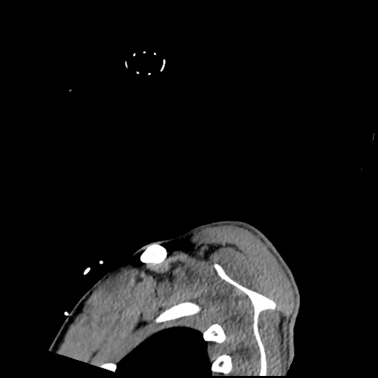 Atlanto-occipital dissociation (Traynelis type 1), C2 teardrop fracture, C6-7 facet joint dislocation (Radiopaedia 87655-104061 D 92).jpg