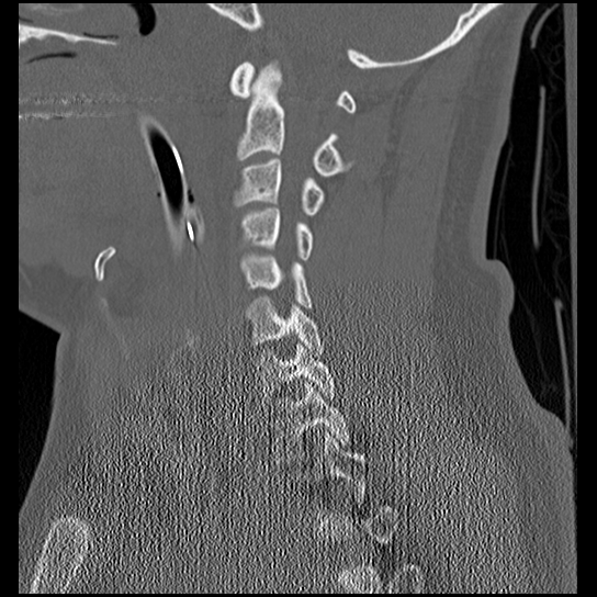 Atlanto-occipital dissociation injury (Radiopaedia 29274-29698 Sagittal bone window 25).png