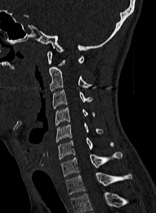 Atlantoaxial subluxation (Radiopaedia 44681-48450 Sagittal bone window 91).jpg