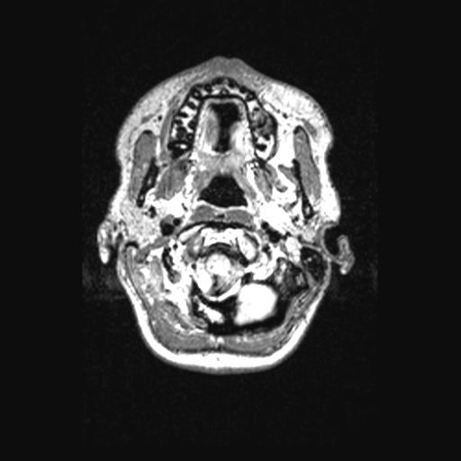 Atretic encephalocoele with inferior vermis hypoplasia (Radiopaedia 30443-31108 Axial 19).jpg
