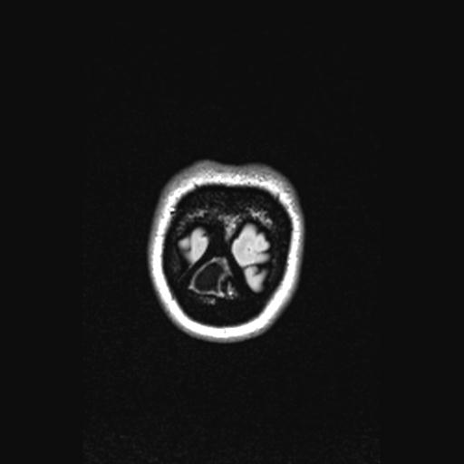 Atretic encephalocoele with inferior vermis hypoplasia (Radiopaedia 30443-31108 Coronal FLAIR 14).jpg