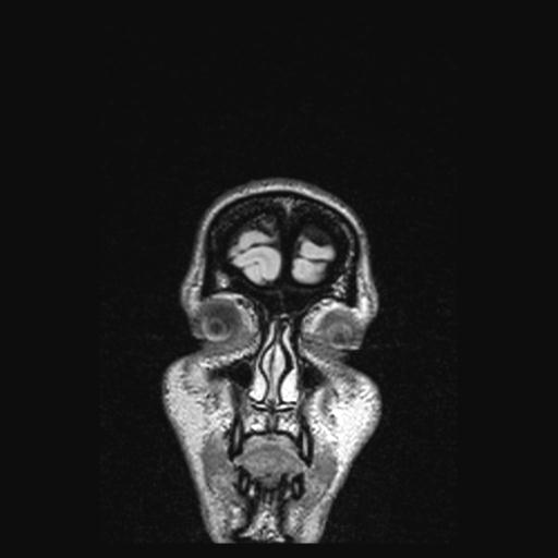 File:Atretic encephalocoele with inferior vermis hypoplasia (Radiopaedia 30443-31108 Coronal FLAIR 170).jpg