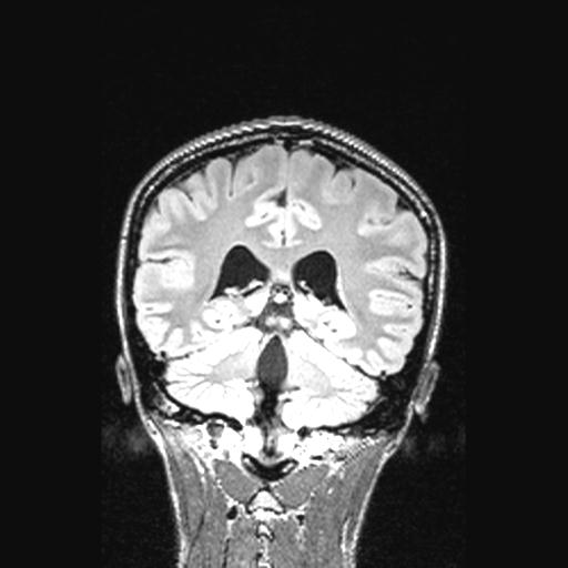 Atretic encephalocoele with inferior vermis hypoplasia (Radiopaedia 30443-31108 Coronal FLAIR 70).jpg