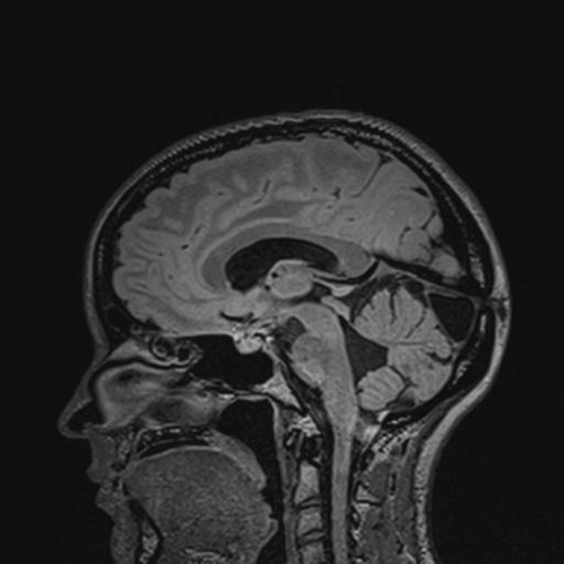 Atretic encephalocoele with inferior vermis hypoplasia (Radiopaedia 30443-31108 Sagittal FLAIR 83).jpg