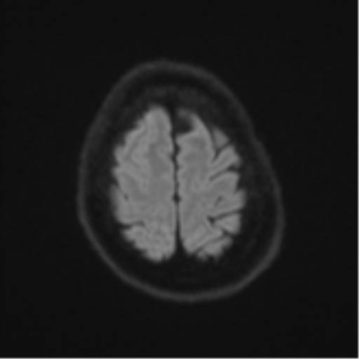 File:Atypical meningioma (WHO Grade II) (Radiopaedia 54742-60981 Axial DWI 52).png
