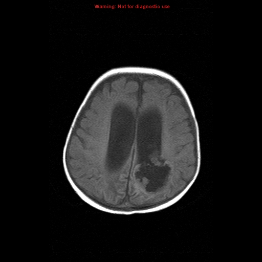 File:Atypical teratoid rhabdoid tumor (Radiopaedia 10712-11183 Axial T1 5).jpg