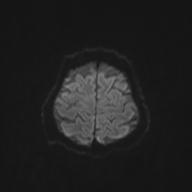Autoimmune limbic encephalitis (Radiopaedia 30363-31005 Axial B0 and DWI 59).jpg