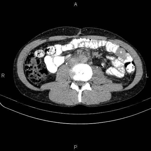 File:Autoimmune pancreatitis (Radiopaedia 84925-100431 Axial C+ delayed 46).jpg