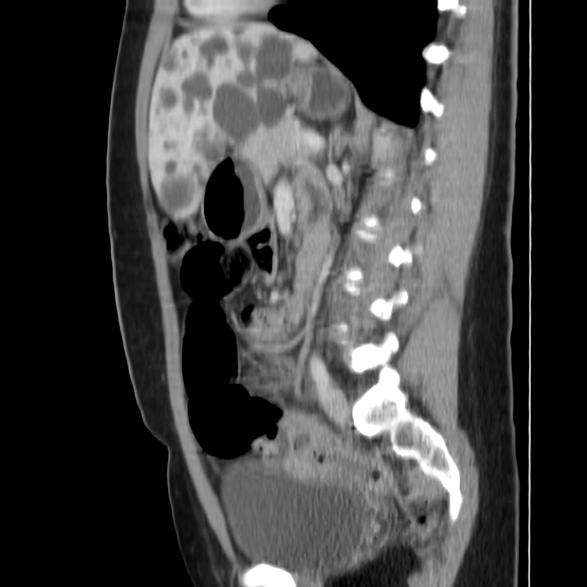 Autosomal dominant polycystic kidney disease (Radiopaedia 23061-23093 F 33).jpg