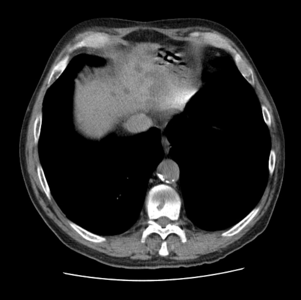 Autosomal dominant polycystic kidney disease (Radiopaedia 27851-28094 Axial non-contrast 45).jpg