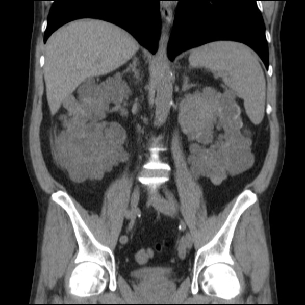 File:Autosomal dominant polycystic kidney disease (Radiopaedia 36539-38101 C 40).jpg