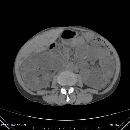 File:Autosomal dominant polycystic kidney disease (Radiopaedia 44122-47684 Axial 22).jpg