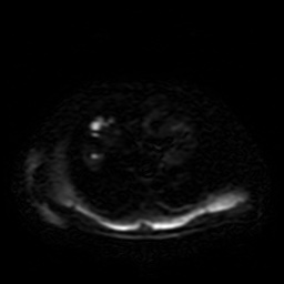 Autosomal dominant polycystic kidney disease (Radiopaedia 50259-55611 Axial DWI 1).jpg