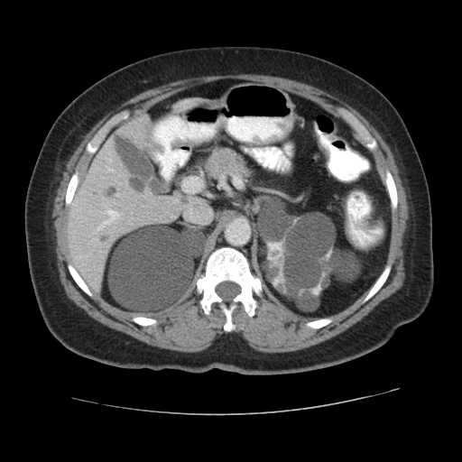 Autosomal dominant polycystic kidney disease with hepatic involvement (Radiopaedia 32693-33662 B 24).jpg