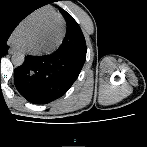 Avascular necrosis after fracture dislocations of the proximal humerus (Radiopaedia 88078-104653 D 95).jpg