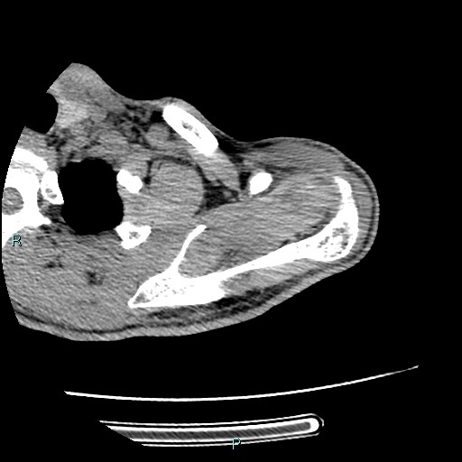 File:Avascular necrosis after fracture dislocations of the proximal humerus (Radiopaedia 88078-104655 D 32).jpg