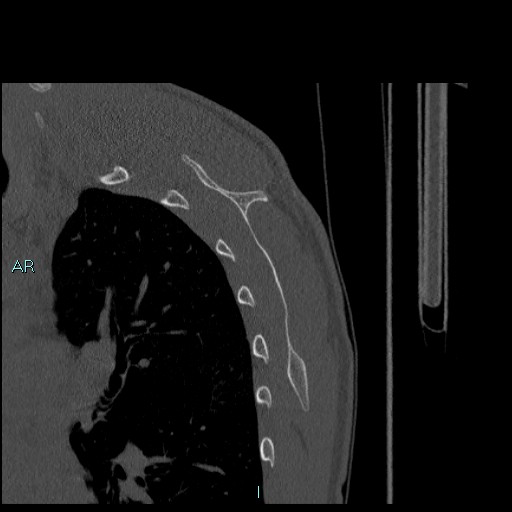 File:Avascular necrosis after fracture dislocations of the proximal humerus (Radiopaedia 88078-104655 Sagittal bone window 71).jpg