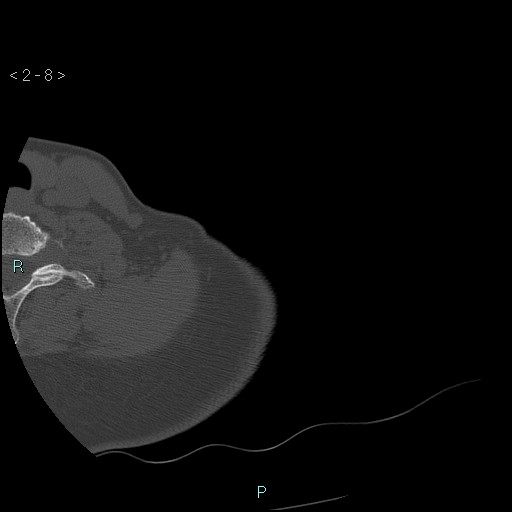 Avascular necrosis of the shoulder - Cruess stage I (Radiopaedia 77674-89887 Axial bone window 2).jpg