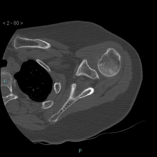 File:Avascular necrosis of the shoulder - Cruess stage I (Radiopaedia 77674-89887 Axial bone window 20).jpg