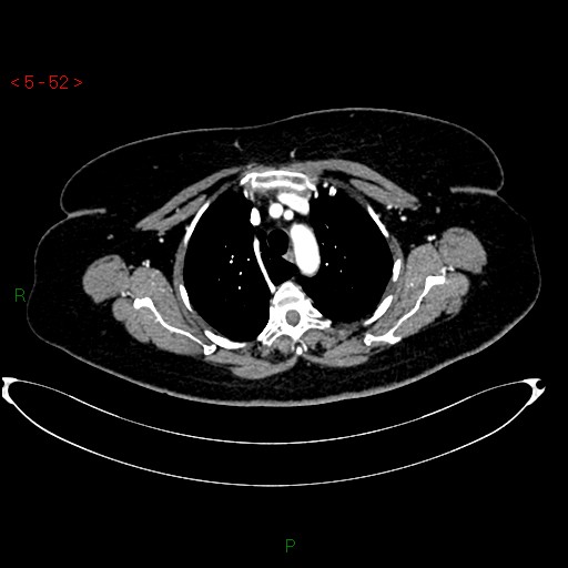Azygos fissure and lobe (Radiopaedia 47620-52278 A 38).jpg