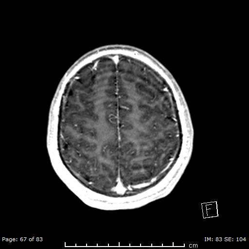 File:Balo concentric sclerosis (Radiopaedia 61637-69636 Axial T1 C+ 67).jpg