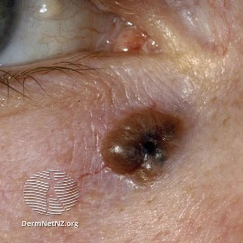 Basal cell carcinoma affecting the face (DermNet NZ lesions-bcc-face-0625).jpg