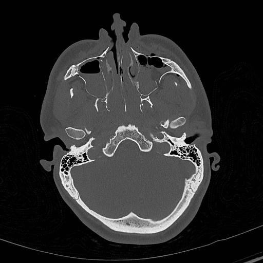 File:Base of skull fracture with bilateral Le Fort fractures (Radiopaedia 47094-51638 Axial bone window 25).jpg