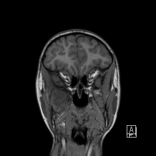 Base of skull rhabdomyosarcoma (Radiopaedia 32196-33142 Coronal T1 9).jpg