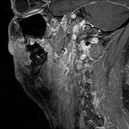 File:Base of tongue squamous cell carcinoma (Radiopaedia 31174-31884 F 56).jpg