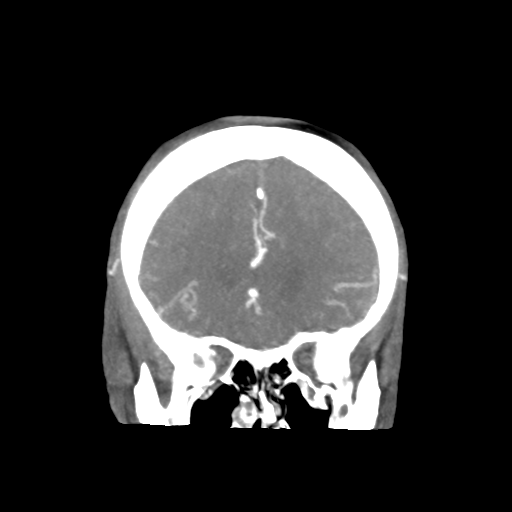 Basilar and bilateral vertebral artery occlusion (Radiopaedia 45592-49723 B 31).png