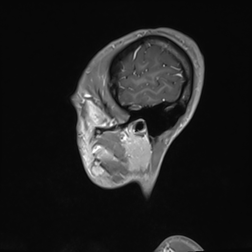 File:Basilar artery perforator aneurysm (Radiopaedia 82455-97733 G 132).jpg